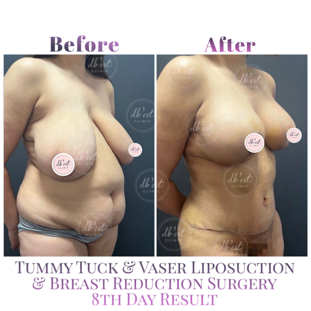 Before and After Result